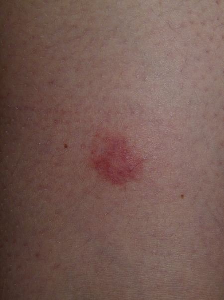 Such spots may appear due to the usage of lidocaine.