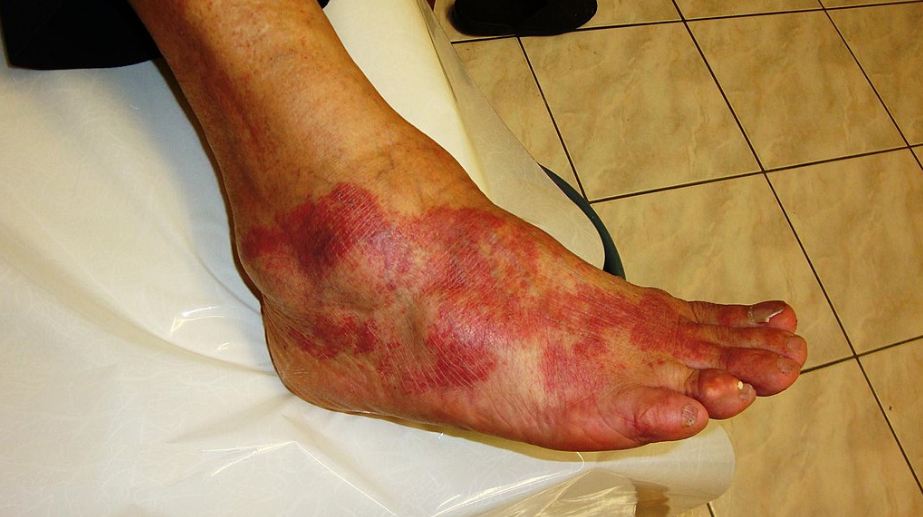 Inflammation can be very painful which is why you should focus on remedies to resolve it. 