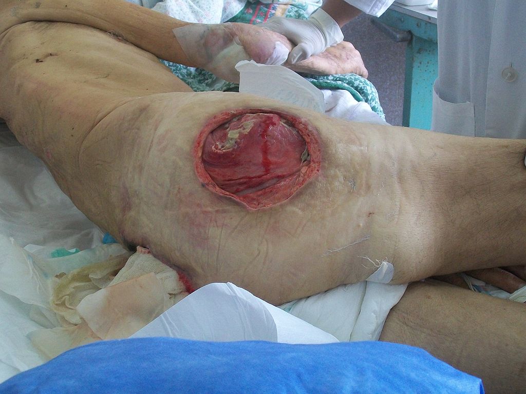 Bedsore, Pressure Ulcer