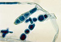 Tinea Cruris, Jock Itch