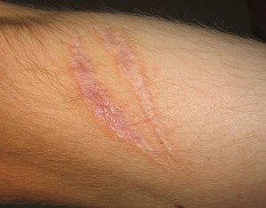 Scar