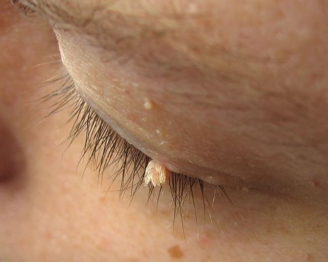Wart on the eye