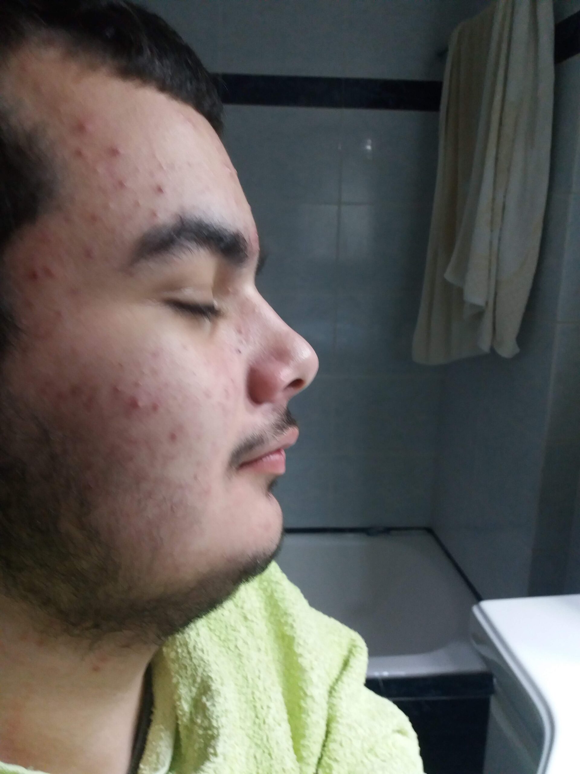 A typical case of a teenager with acne, pimples in various parts of the head