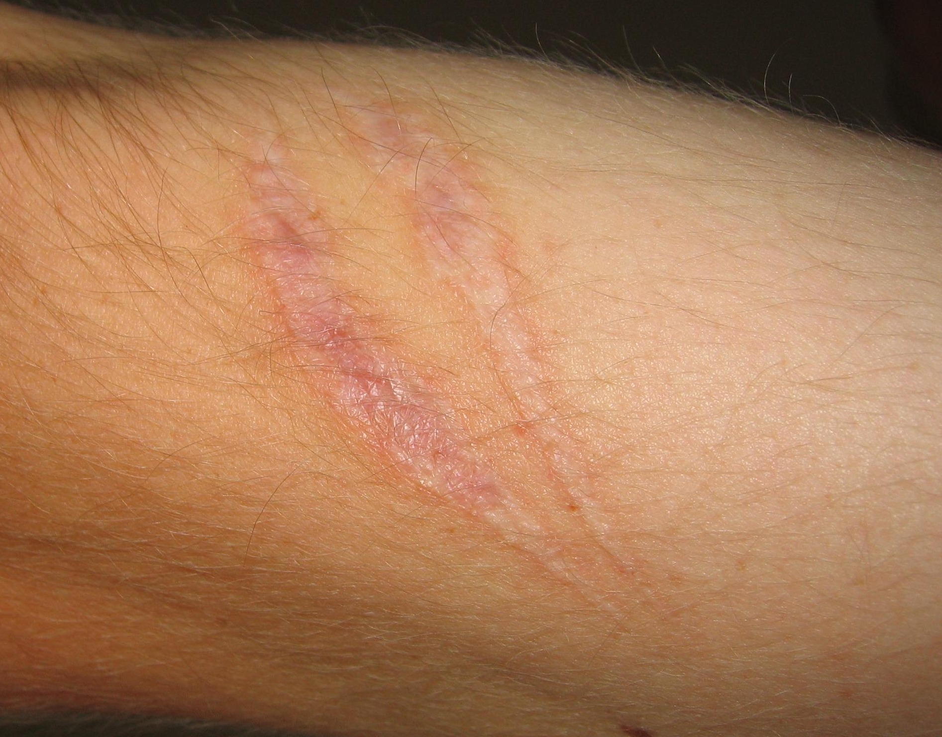 Scar tissue on an arm