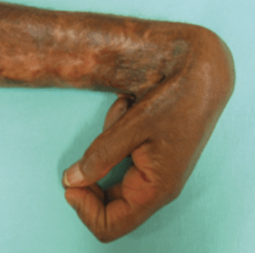 Wound contracture following deep burn injury