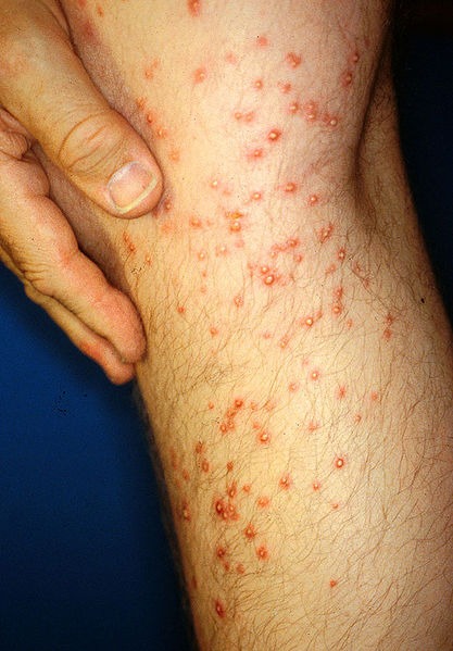 Fire ant bites on a man’s leg