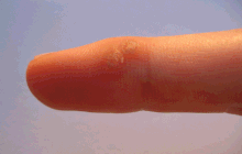 Causes of Warts