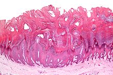 Types of Warts