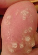 What is a Wart?