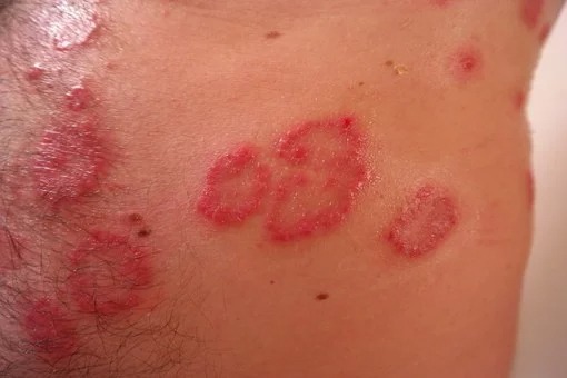 Side Effects of Lidocaine