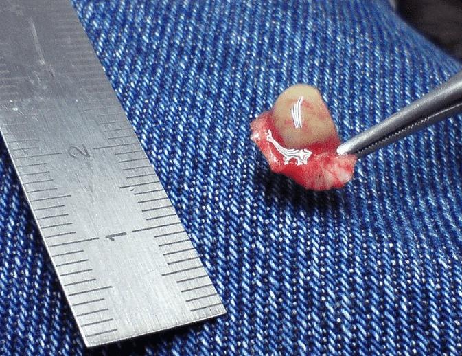 A wart that was surgically removed after all other procedures failed. 