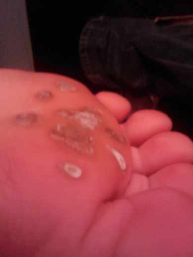 Don't let many warts grow. Treat them timely.