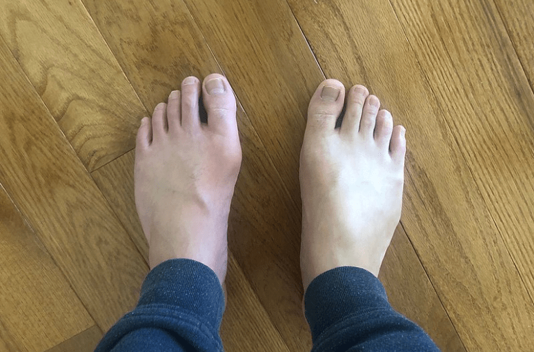 Gout on the big toe of the left foot. It is quite bearable which is why the person can stand
