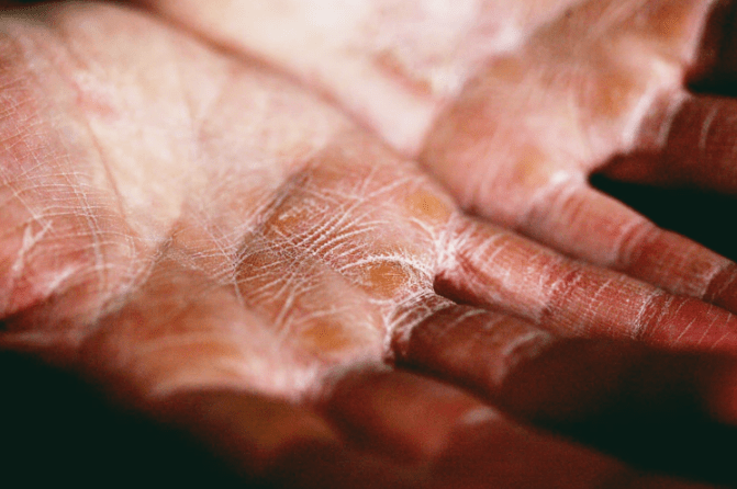 Causes of Dry Skin