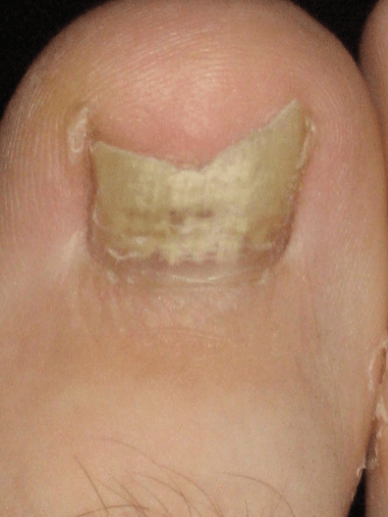 Nail Fungus may not be painful to every infected person.