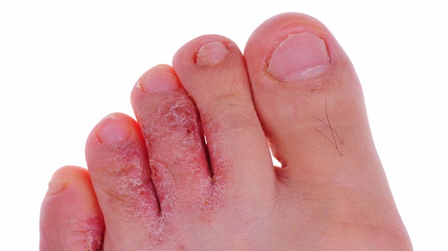 athletes foot home remedies