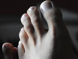 Arthritis of the feet