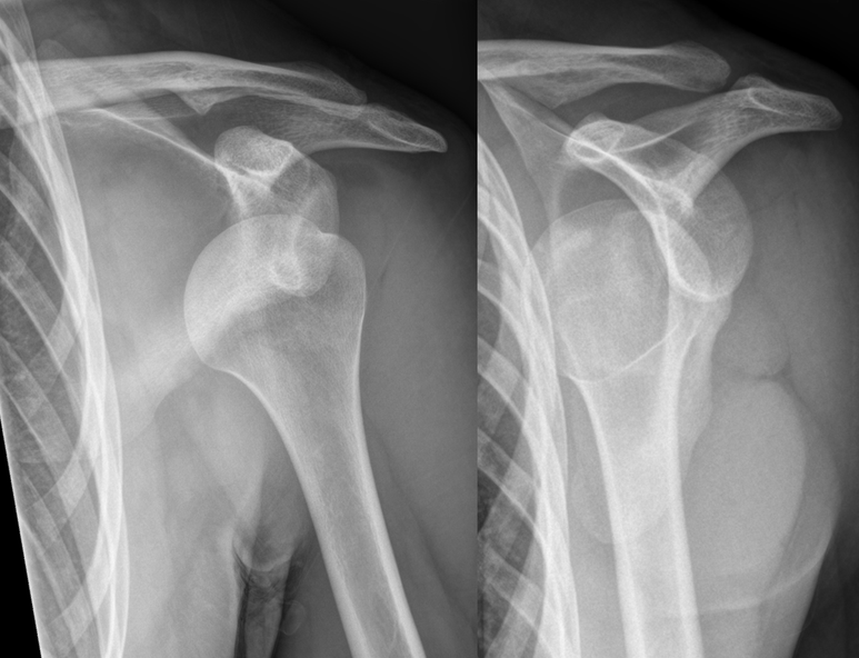 An X-ray showing dislocated shoulder