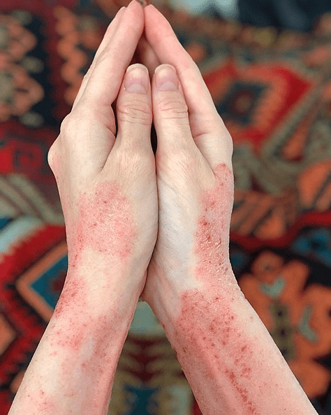 Eczema on the arms and hands