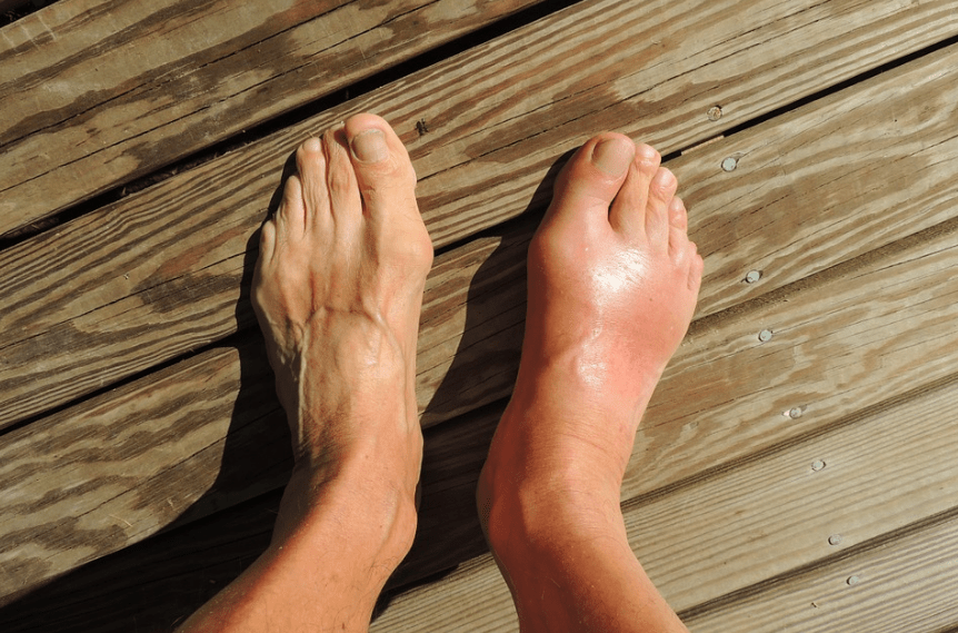 A foot with Gout disorder