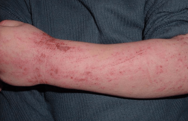 Atopic dermatitis on a child’s hand
