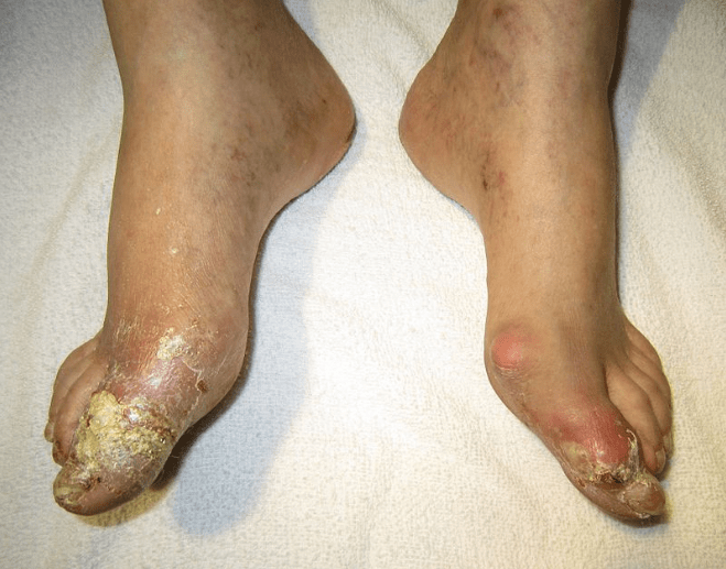 Gout with ruptured tophi