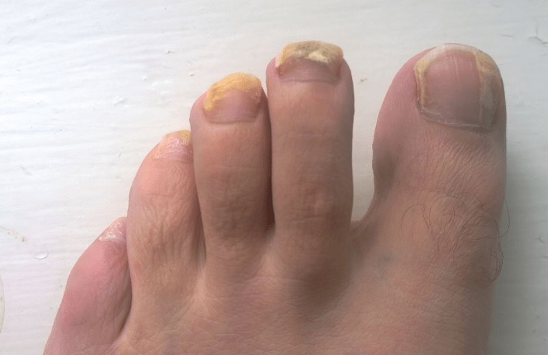 Nail Fungus may occur on multiple nails.