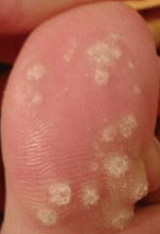 Plantar Wart Forming on the toe.