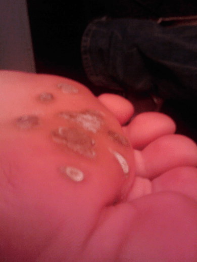 Plantar warts may appear on the sole. 