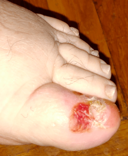 The worst case of Nail Fungus includes bleeding.