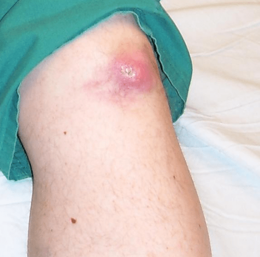 Tophus at the Knee