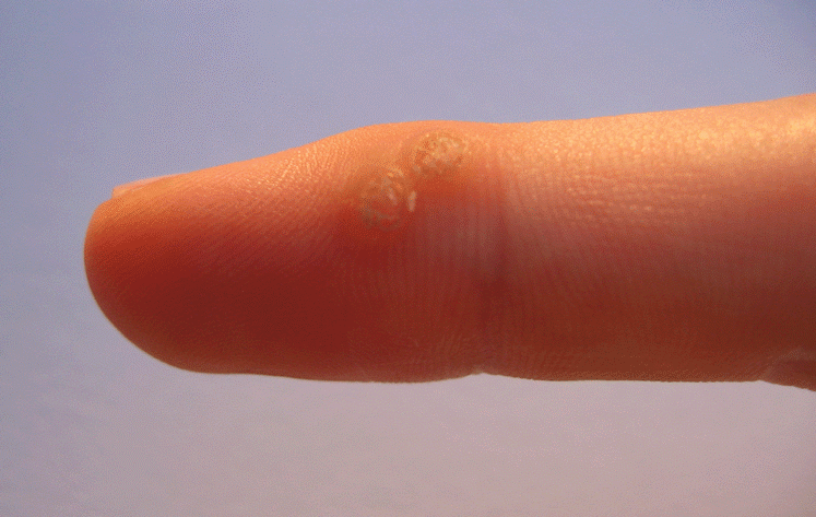 Warts appearing on fingers. 