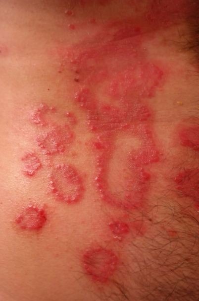 Inflammatory reaction on the body causes redness.
