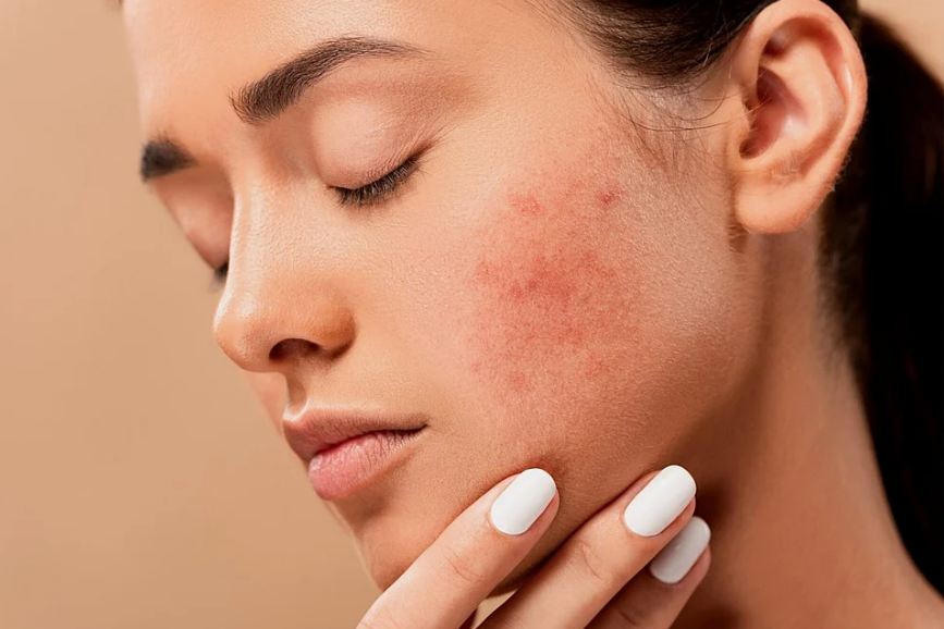 acne on a woman’s face