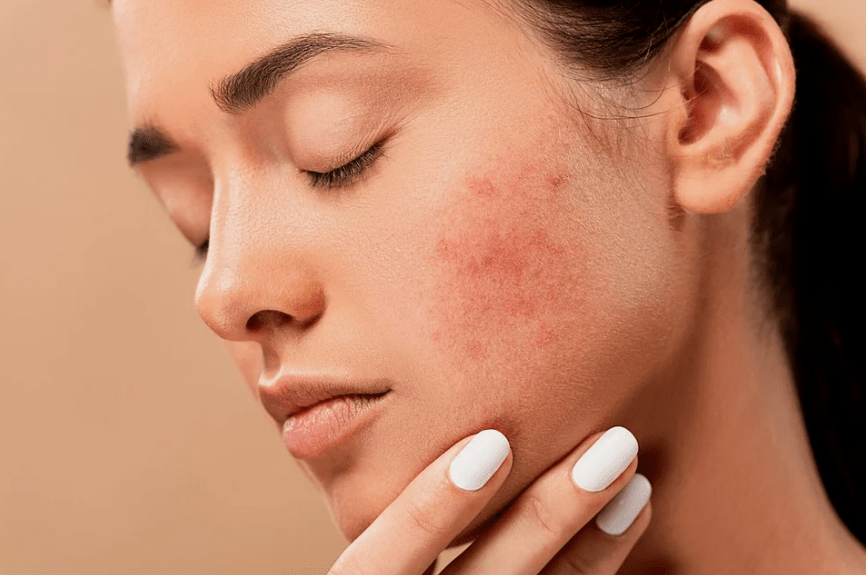 acne-pimples-spots-zits-skin