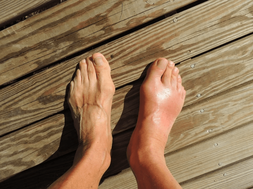 gout inflammation in the right feet of a person