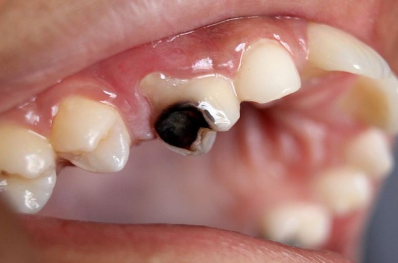 Cavities are one main cause of toothache. 