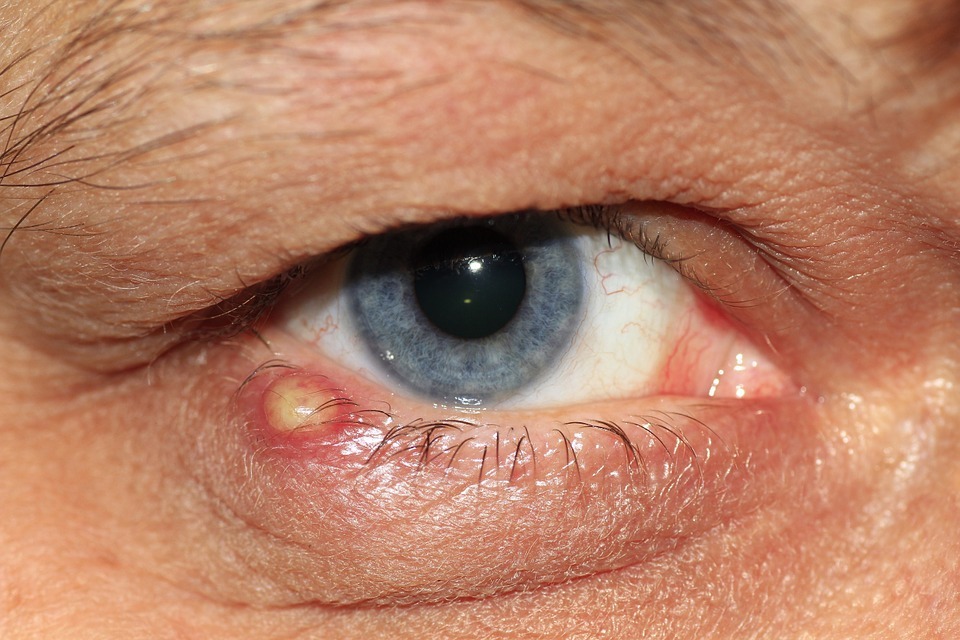 Inflammation causing eye pus. 