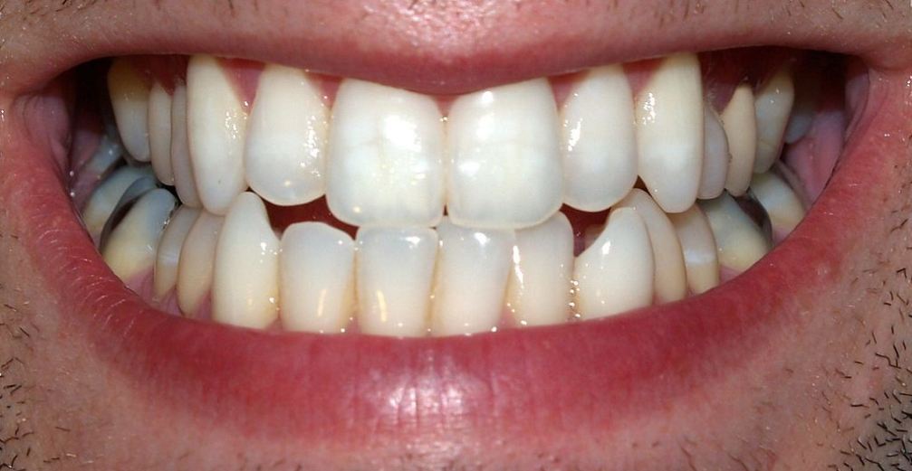 Teeth grinding is a bad habit for teeth health. 