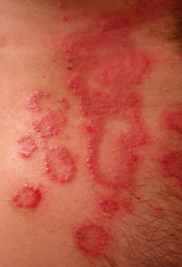 A close-up of inflamed skin