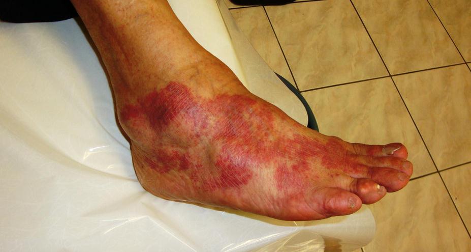 An inflamed foot