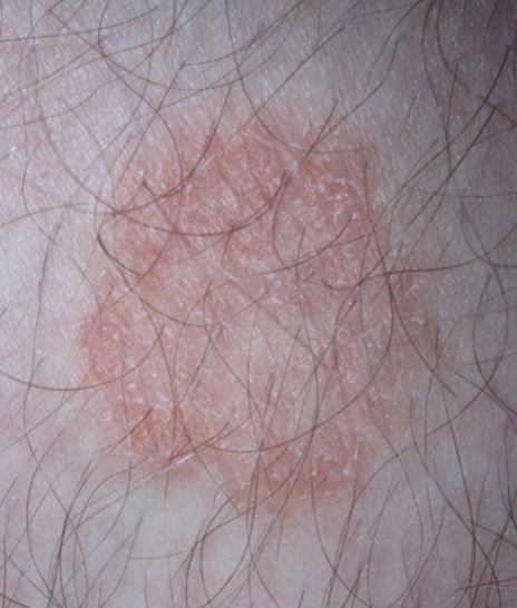 Dermatophytes close-up on the skin of a man