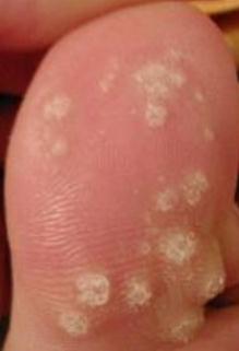 warts on a toe