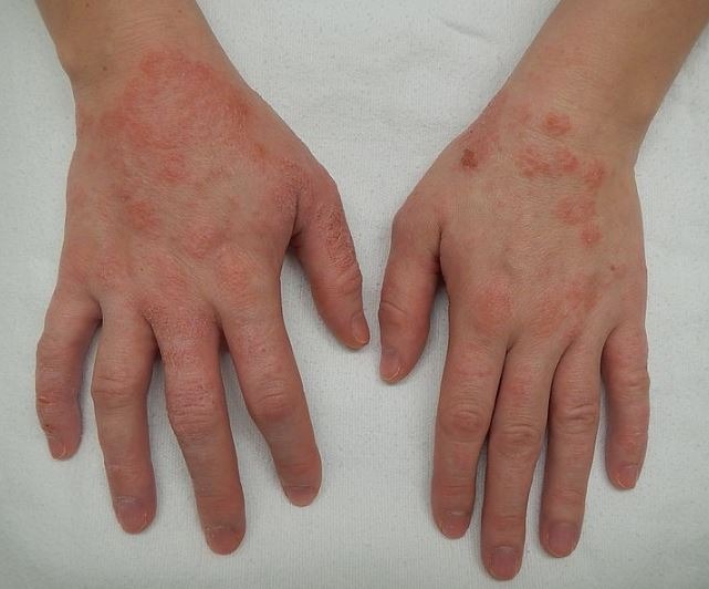 a moderate case of dermatitis of the hands