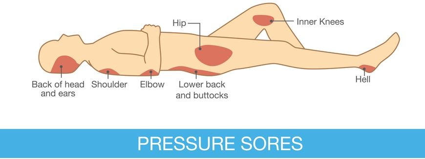 pressure sores area on the human body