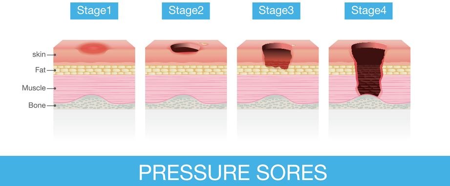 stages of bed sores of a patient’s skin which extends from skin into muscles and bone