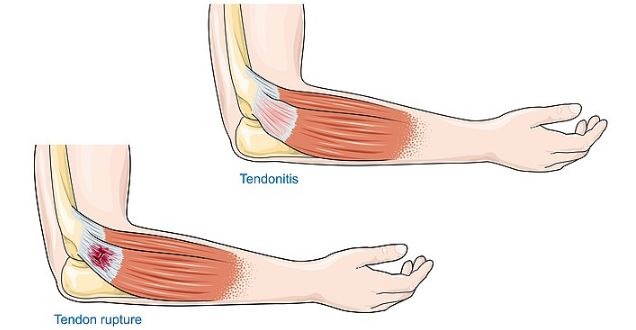 a diagram illustrating tendonitis and tendon rupture