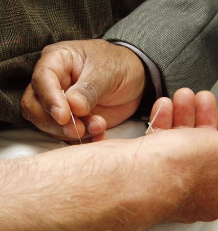 a person’s arm being acupunctured