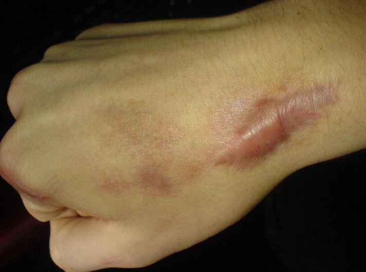 a postoperative keloid on the wrist