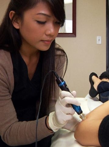 a woman performing collagen induction therapy for scar reduction using a microneedle stamping device